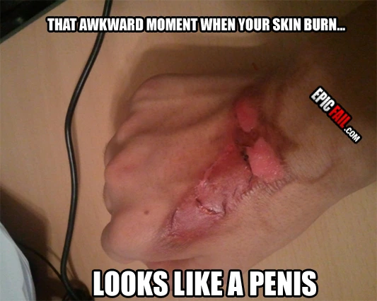Moment: epic Skin Burn Fail