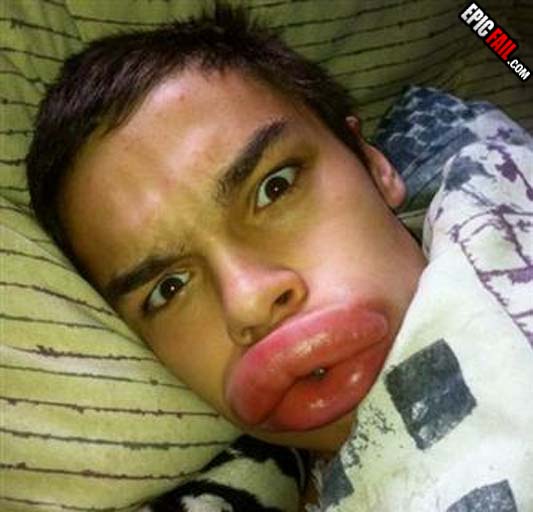 Scene: epic Lip Enhancement Fail